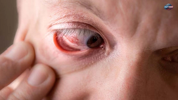 गर्मियों में बढ़ जाता है Eye Stroke का खतरा – जानिए लक्षण, कारण और बचाव के उपाय